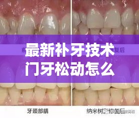 最新补牙技术门牙松动怎么办：门牙补过后松动 